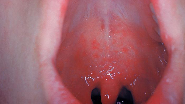 什么麻疹看起来像