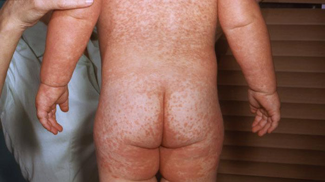 什么麻疹看起来像