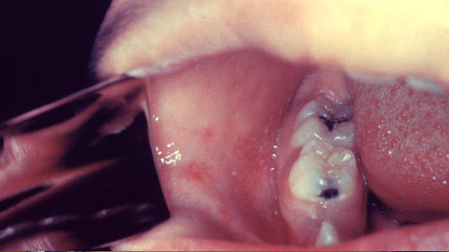什么麻疹看起来像