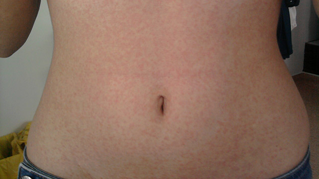 什么麻疹看起来像